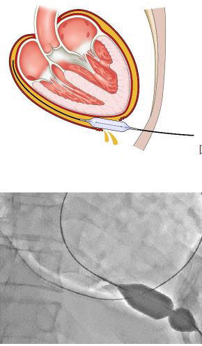 バルーン心膜開窓術のイメージ図