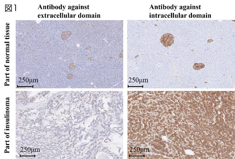 インスリノーマ内で発現するSSTR2とSSTR5の細胞外ドメインは変性している可能性を表した画像